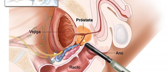 câncer de próstata