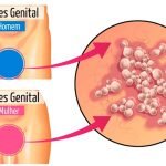 tratamentos para herpes genital